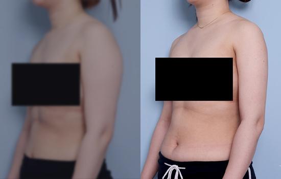 169cm/70.1kg/팔미니(바깥쪽)/1700cc/4개월