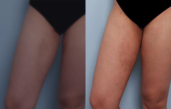 160cm/47kg/허벅지재수술/650cc/2개월
