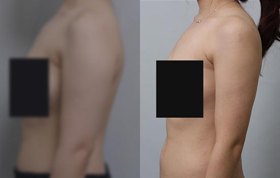 150cm/50.2kg/팔/800cc/6개월