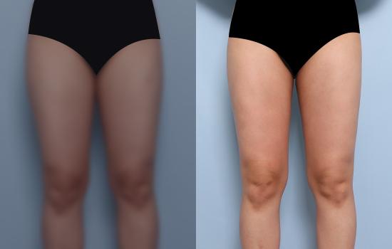 163cm/54.6kg/허벅지 지방흡입 /1800cc/2개월