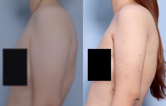 160cm/53.6kg/팔/1500cc/2주후