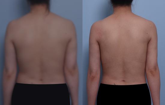161cm/54.3kg/팔 지방흡입/1050cc/4주