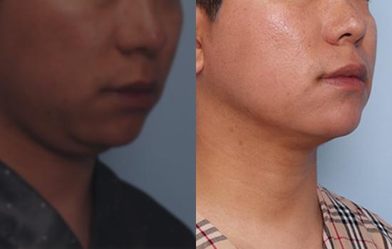 170cm/70kg/턱 지방흡입+벨로디2/65cc/1개월 