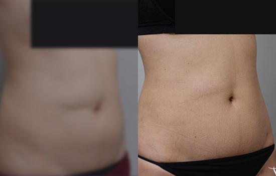 157cm/54kg/복부미니 옆구리/900cc/8개월