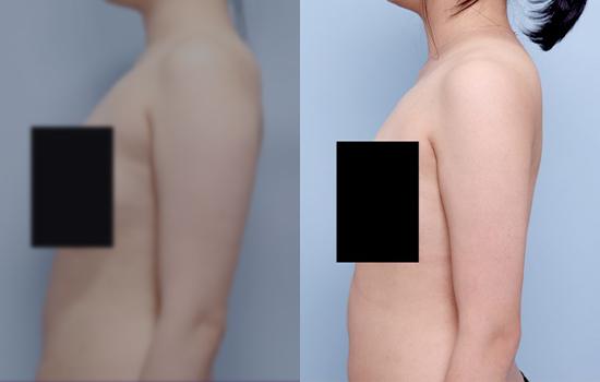 163cm/62.1kg/팔전체/1500cc/1개월