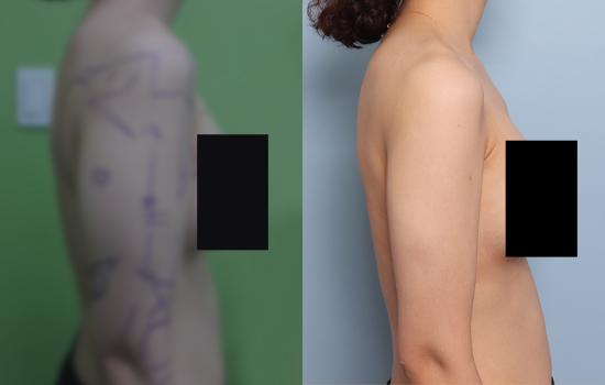 167cm/58.4kg/팔 지방흡입 /1300cc/1개월