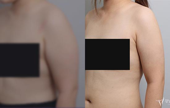 160cm/68.3kg/팔/1600cc/7개월