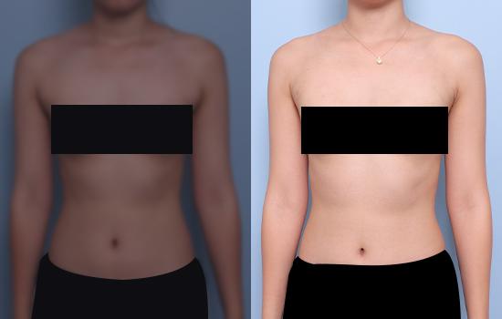 165cm/53kg/팔 지방흡입 /300cc/3개월