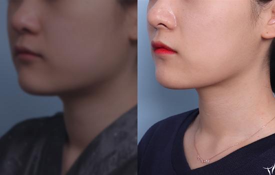154cm/47kg/턱 지방흡입+벨로디2/25cc/10개월