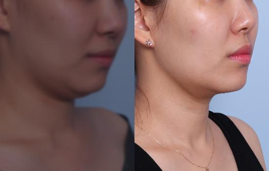 턱 지방흡입+벨로디2/35cc/28일 