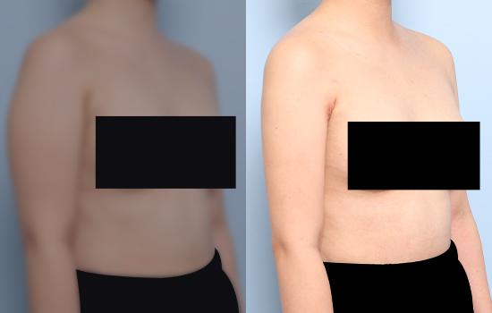 157cm/53kg/팔 지방흡입 /1400cc/3개월