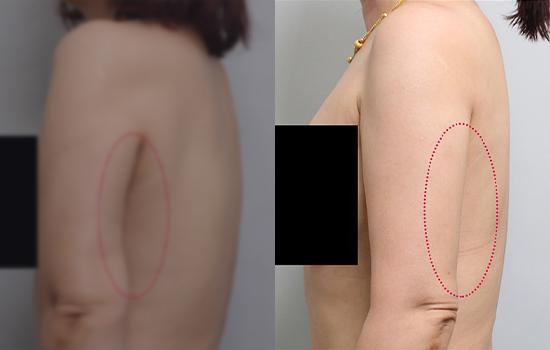 152cm/51.6kg/팔재수술/950cc/3개월