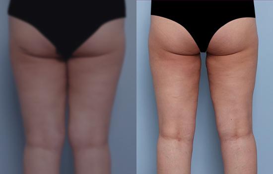 158cm/55.1kg/허벅지지흡/2500cc/2개월