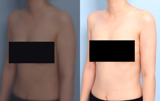 160cm/47.9kg/팔 지방흡입 /750cc/2개월