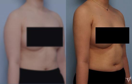 158cm/61.4kg/팔 지방흡입/1200cc/2개월 