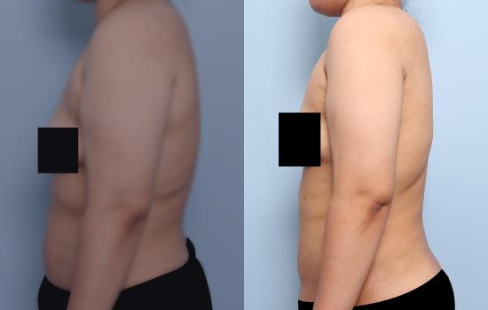 168cm/81.7kg/팔 지방흡입/2500cc/1개월