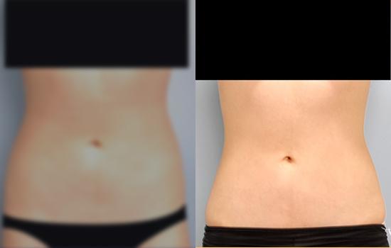 165cm/58.9kg/복미니(옆구리)/1000cc/2주후
