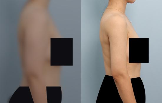 3개월 후/161cm/60kg/1900cc