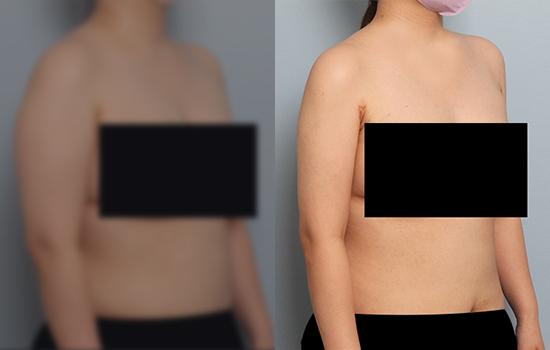 158cm/65kg/팔+등/3000cc/1개월