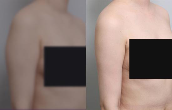 156cm/47.3kg/마른체형 팔/900cc/4개월