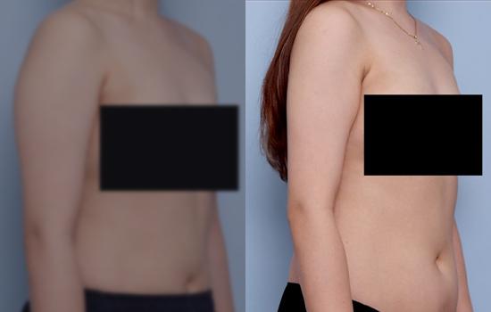 162cm/57.5kg/팔/1100cc/1개월
