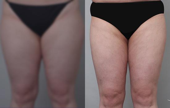 158cm/65.9kg/허벅지/3400cc/3개월