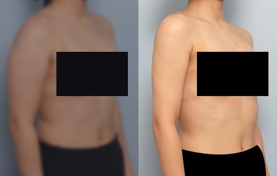 157cm/59kg/팔 지방흡입/1200cc/6개월 후