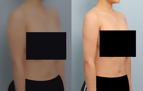 3개월 후/163cm/56kg/800cc