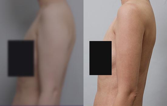 160cm/47kg/팔/750cc/2개월