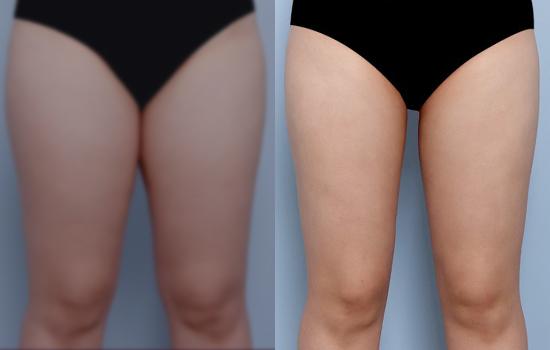 160cm/63kg/허벅지/3700cc/3개월