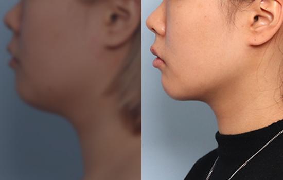153cm/49.7kg/턱 지방흡입+벨로디2 /45cc/7개월