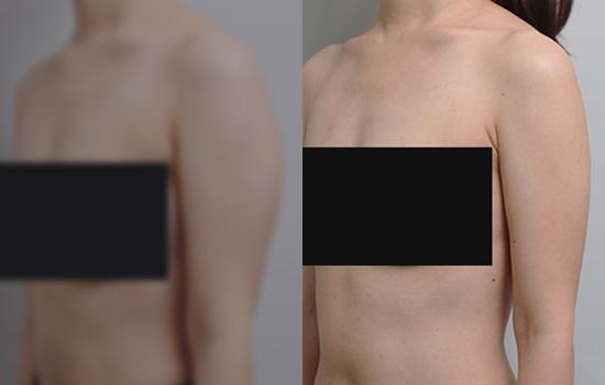155cm/48.6kg/팔/550cc/6개월