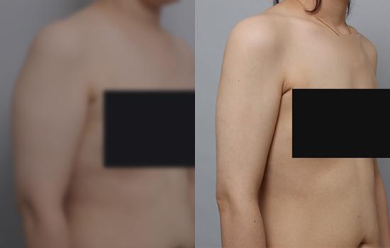 159cm/62.3kg/팔미니/800cc/5개월