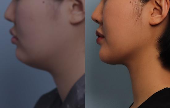170cm/56.8kg/턱 지방흡입+벨로디2/55cc/1개월 