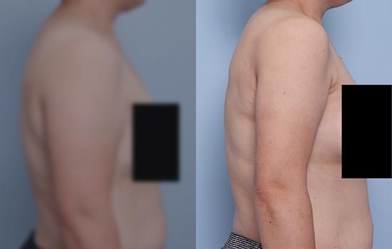 155cm/61.1kg/팔/2000cc/3주
