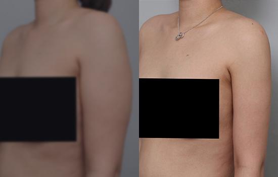 168cm/58.6kg/팔지방흡입/1750cc/3개월