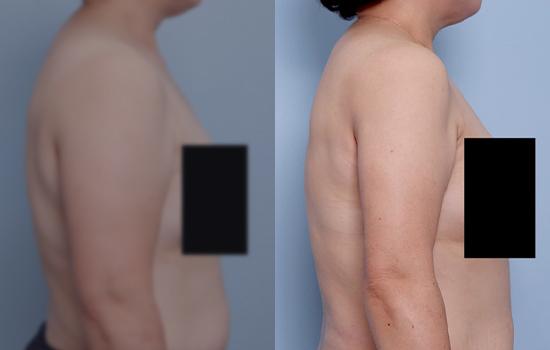 155cm/61.1kg/팔/2000cc/2개월