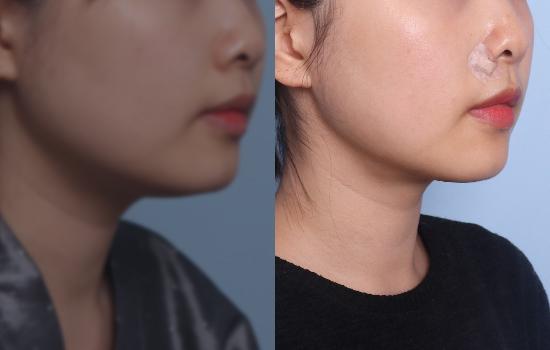 165cm/47kg/턱 지방흡입+벨로디2/35cc/9개월