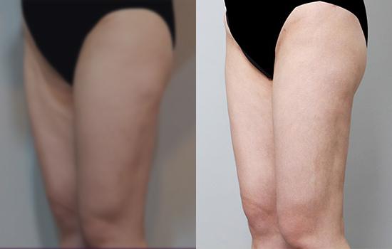 175cm/69.9kg/허벅지재수술/650cc/3개월