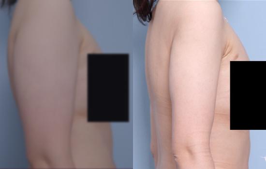 168cm/64.3kg/팔/1500cc/3개월
