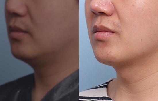 180cm/88.8kg/턱+벨로디/25cc/2개월