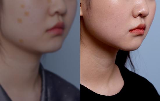 162cm/48.7kg/턱+벨로디2/50cc/3개월