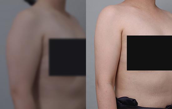 166cm/66.4kg/팔/1500cc/6개월