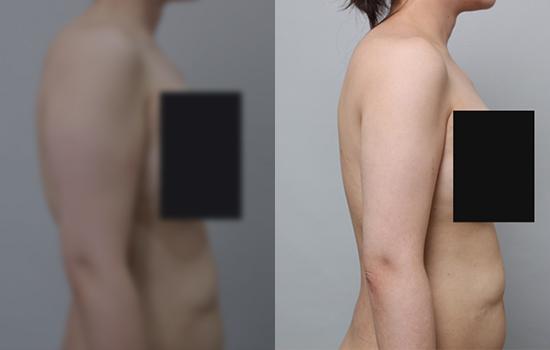 157cm/54kg/팔뚝/950cc/1개월