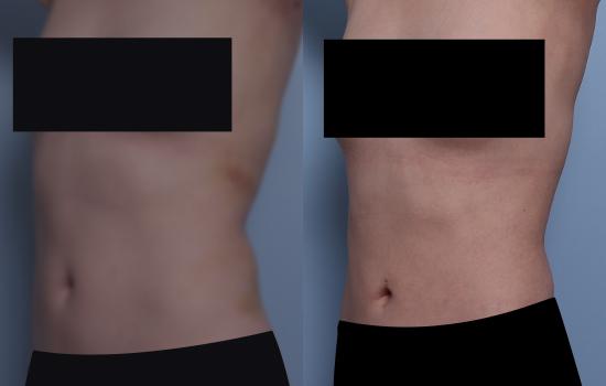 161cm/54.3kg/복부 지방흡입/1400cc/5주