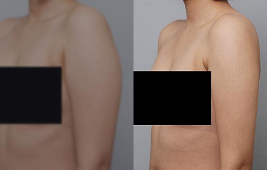 160cm/54.1kg/팔뚝/900cc/3개월