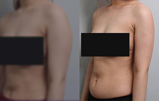 156cm/47.2kg/팔/900cc/4개월