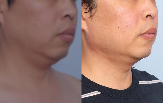 167cm/81kg/턱 지방흡입+벨로디2/55cc/1개월