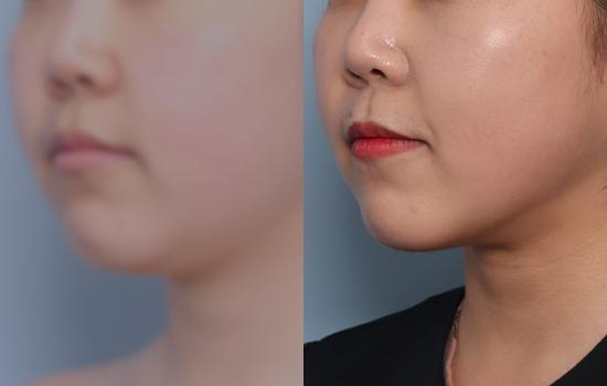 160cm/55kg/턱 지방흡입+벨로디2 /70cc/1개월