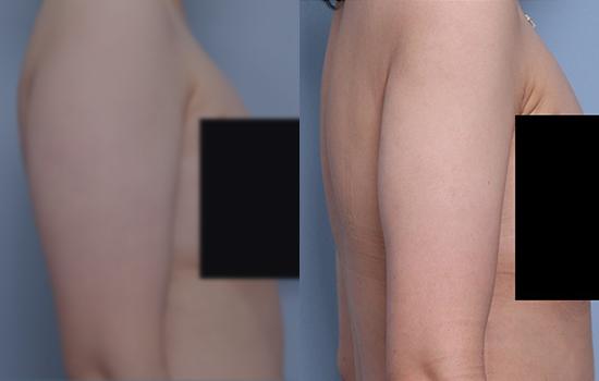 168cm/64.3kg/팔지흡/1500cc/3개월